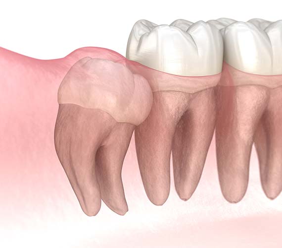 口腔外科（親知らず）
