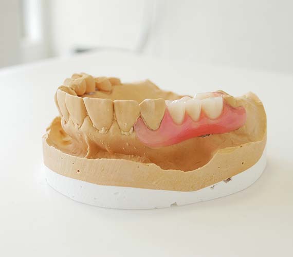 主な入れ歯の種類