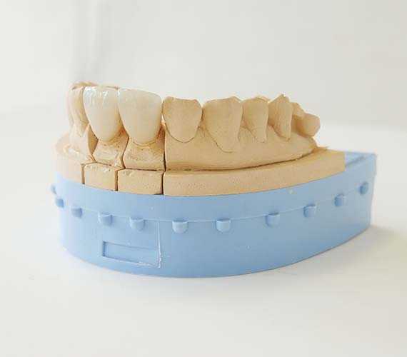 審美補綴（被せ物）