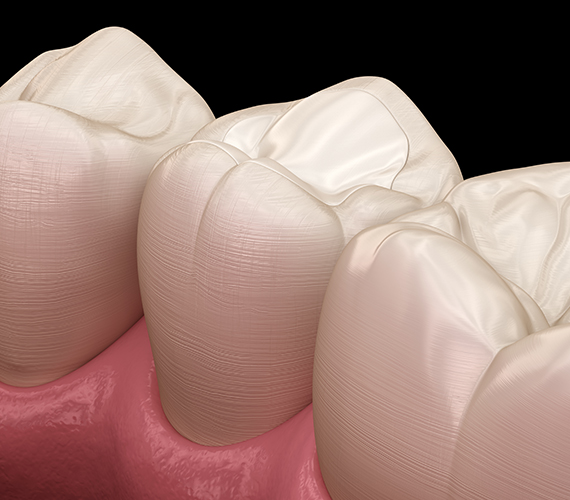 主な詰め物の種類